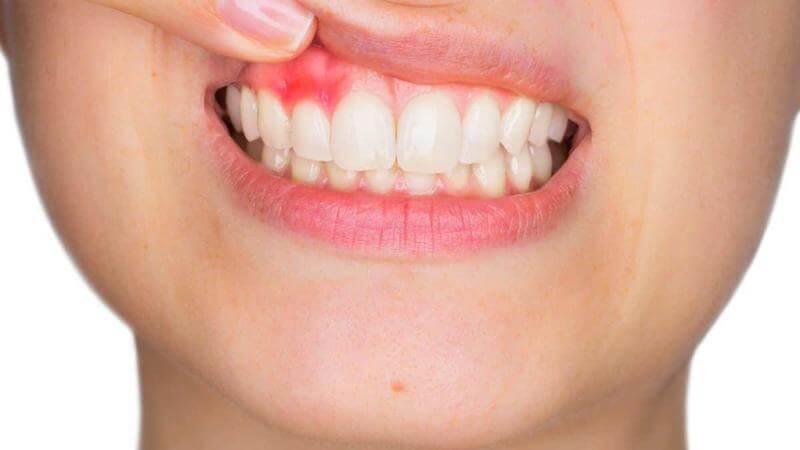 Cloves do a great job healing inflamed gums. 