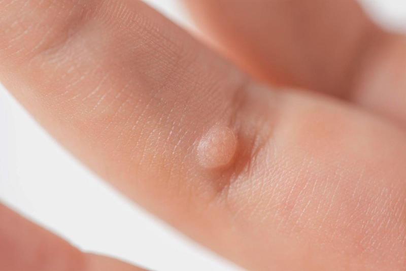 Warts and calluses can be difficult to tell apart. 