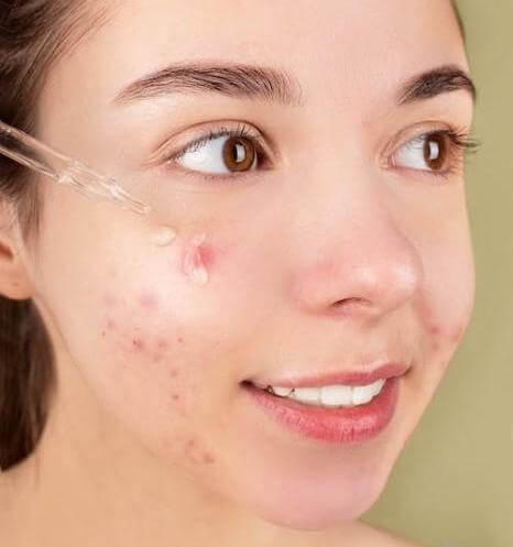 Acne is a form of a cyst that occurs when the skin's pores get clogged with oil, dead skin cells.   