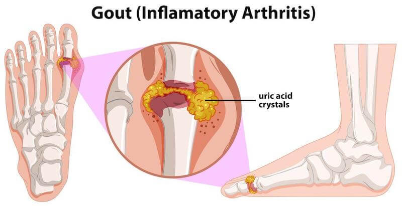 Gout is most commonly found in the joint of the big toe, but all joints are susceptible to gout, even the more rare cases that involve the shoulders.