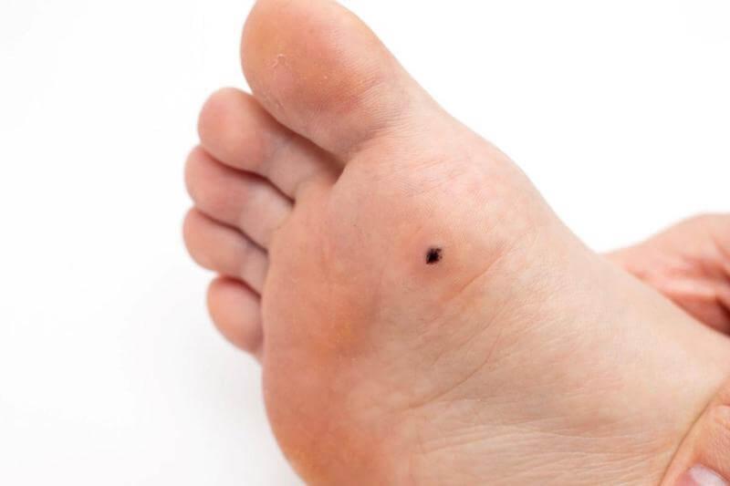 Plantar’s warts can be identified with a black mark in the center, caused by a dried up blood supply. 