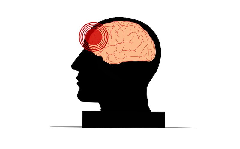 Headaches are a common detox symptom.