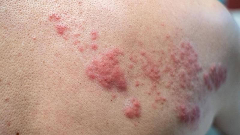 If you see any red or itchy patches of skin that pop up after the use of apricot kernel oil or any product, discontinue use. 