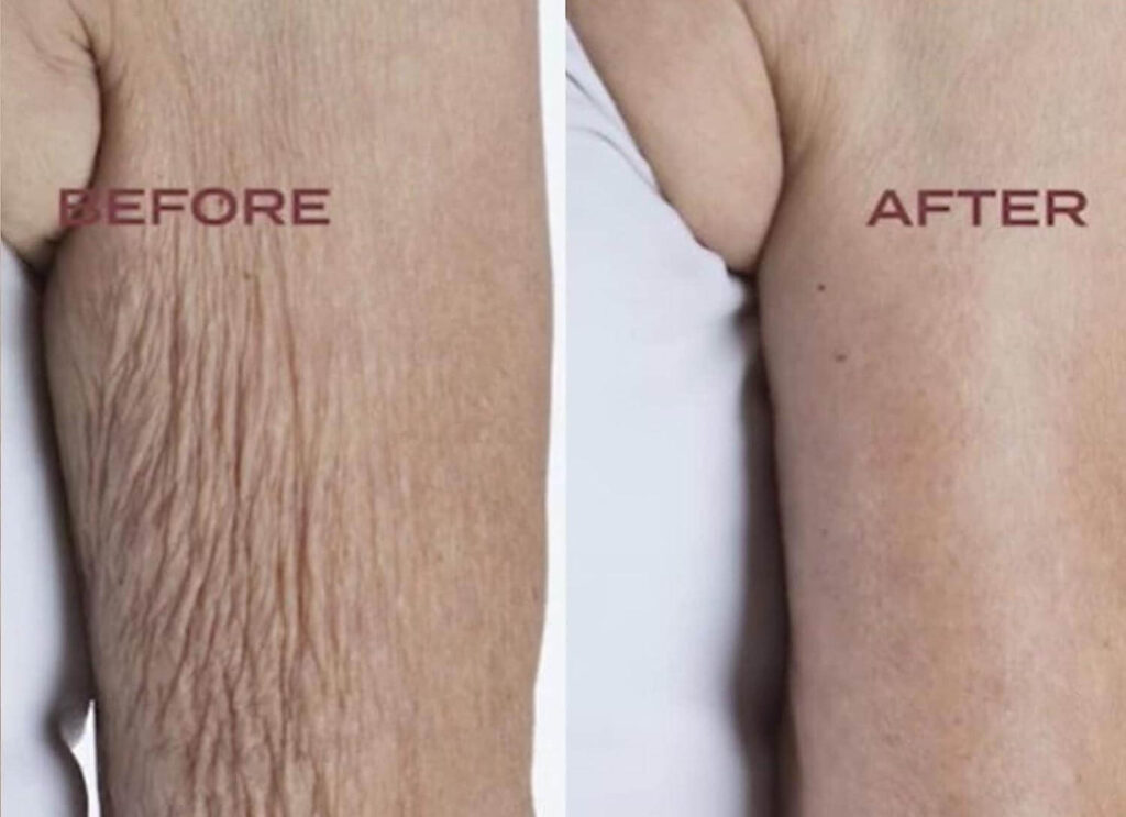 Body Firm Crepe Erase claims to get rid of crepey skin in 8 weeks.
