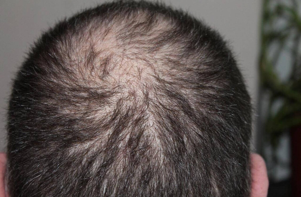 Balding pattern starting on the back of the head.