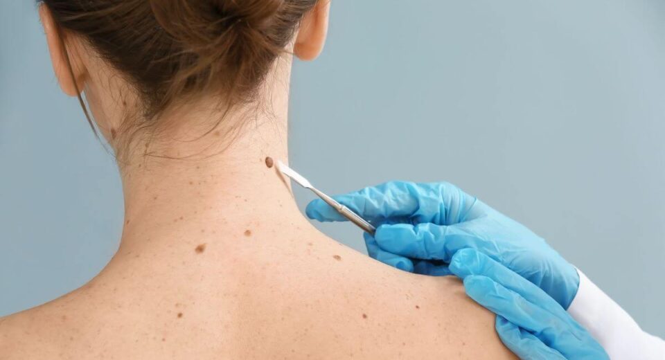 A Skin Tag Removal Tool Will Help You Clear Your Body Of Pesky Tags TheWellthieoen