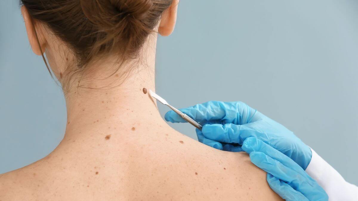 A Skin Tag Removal Tool Will Help You Clear Your Body Of Pesky Tags TheWellthieoen