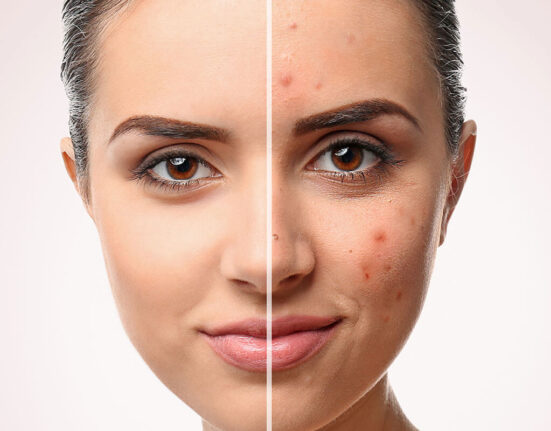 Does Collagen Help With Acne? Discover Your Advantage! TheWellthieone