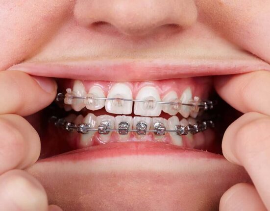 How to Relieve Braces Pain - 4 Natural Methods TheWellthieone