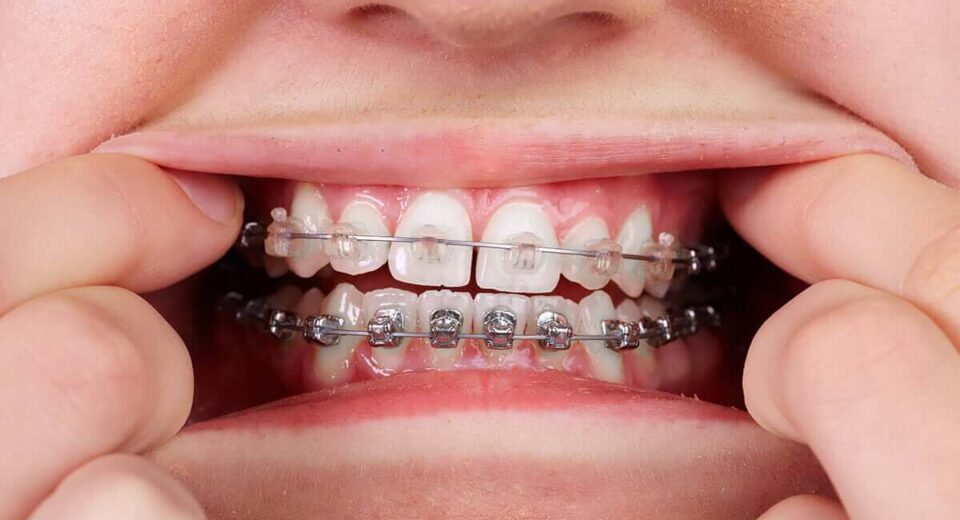 How to Relieve Braces Pain - 4 Natural Methods TheWellthieone